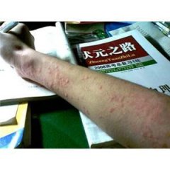 荨麻疹图片
