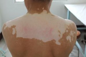 泛发性型白癜风图片