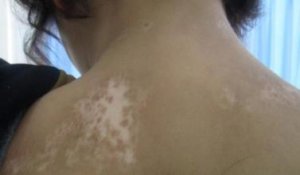 早期白癜风症状图片