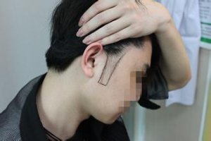鬓角脱发图片