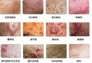 痤疮的症状图片