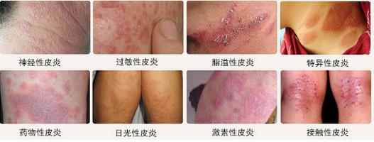 皮炎的不同症状图